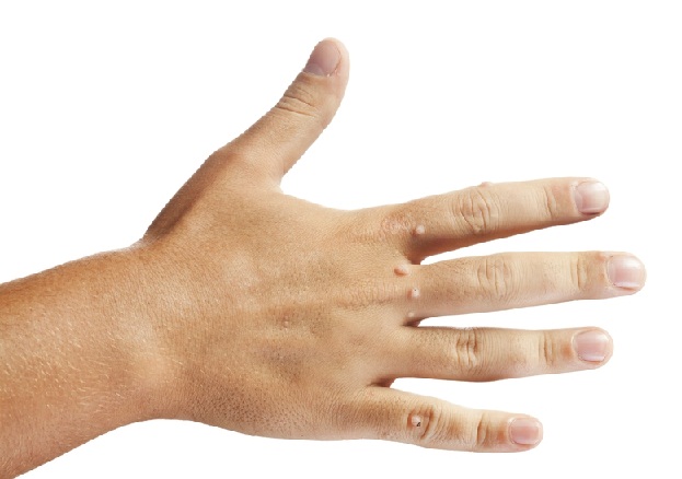 Czy uszkodzenia mechaniczne sprzyjają grzybicy paznokci?